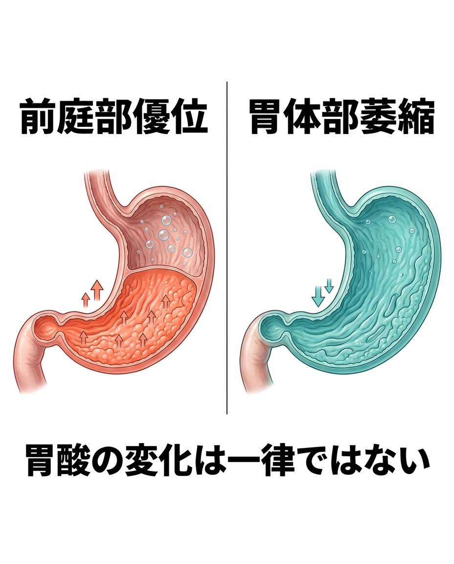 胃炎の分布で胃酸への影響は異なる